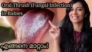 'Oral Thrush in babies | Fungal infection in babies | Malayalam| Clean Baby Mouth'